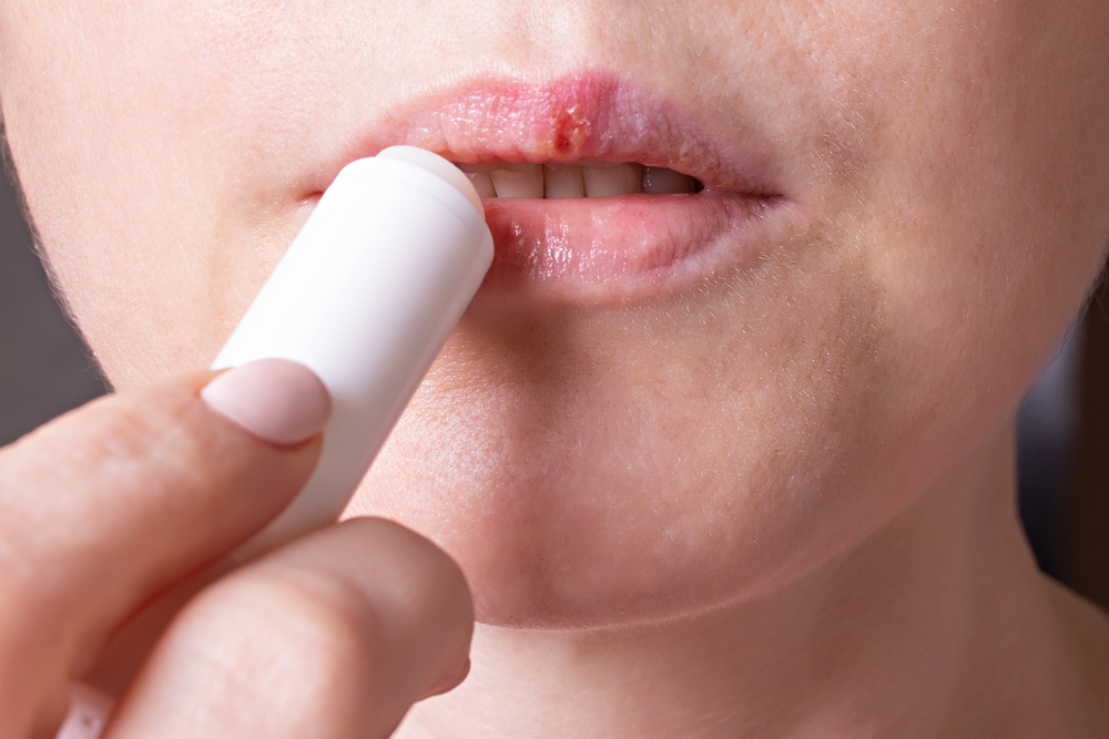 Was tun gegen Herpes? Ursachen und wirkungsvolle Behandlungstipps